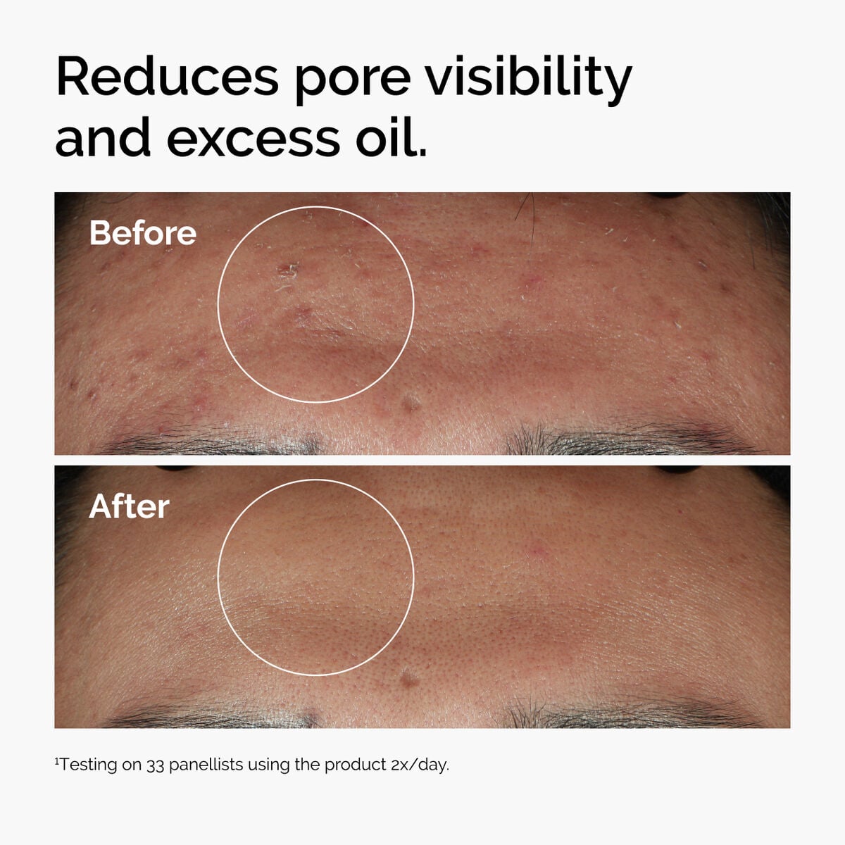 niacinamide-10-zinc-1-w6 ord-niacinamide-zinc-blemish-serum-before-after-pores.jpg