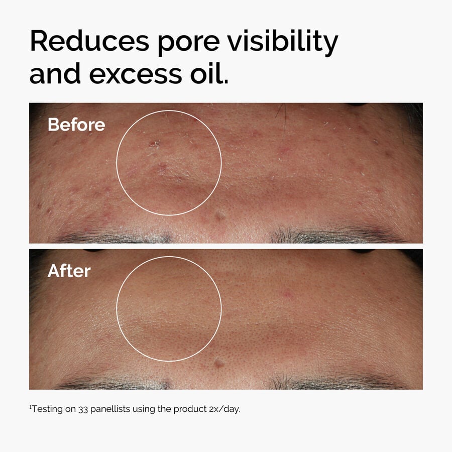 niacinamide-10-zinc-1-w6 ord-niacinamide-zinc-blemish-serum-before-after-pores.jpg
