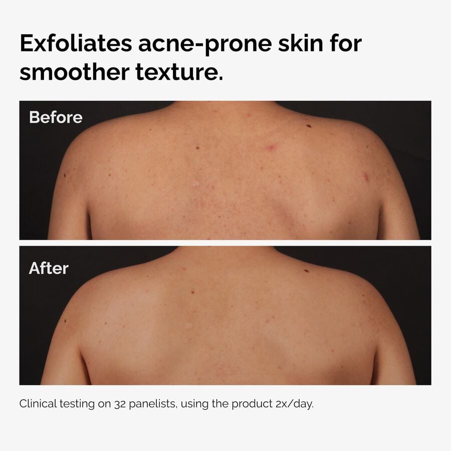 the-body-care-collection-f0 ord-salicylic-acid-body-serum-before-after-graphic-NA.jpg