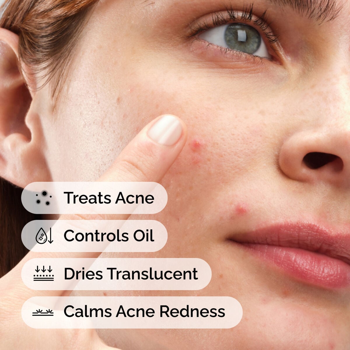 sulfur-10-powder-to-cream-concentrate-h0 ord-sulfur-10pct-powder-to-cream-concentrate-model-application-with-benefits-acne.jpg