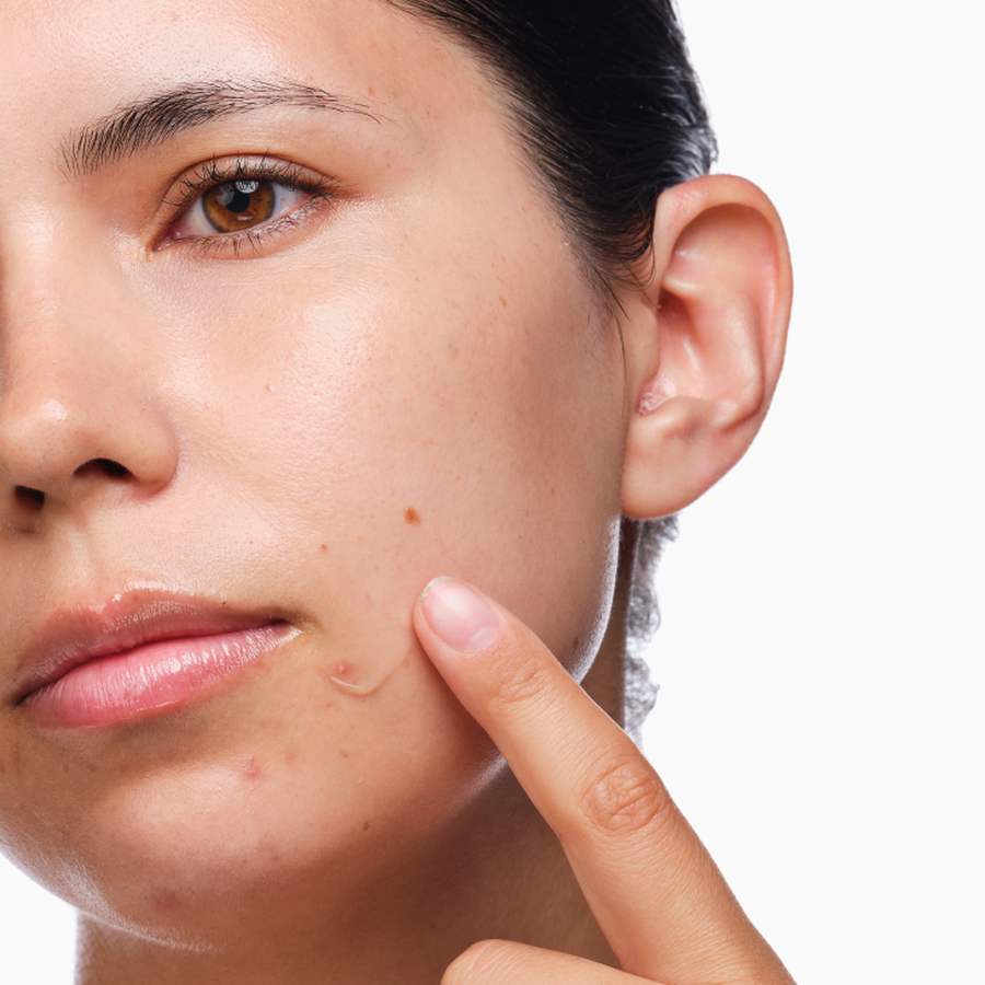 the-acne-set-q1 rdn-the-acne-set-application.png
